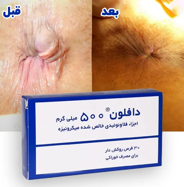 قرص دافلون برای درمان هموروئید