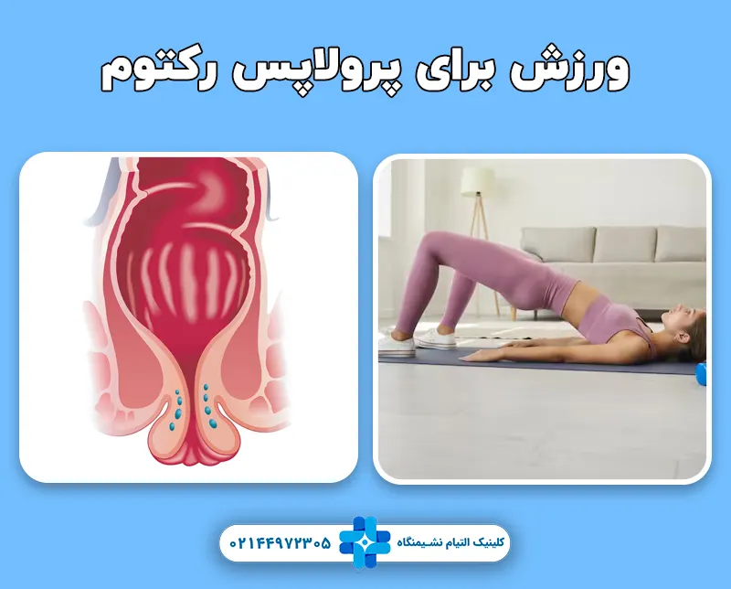 ورزش برای پرولاپس رکتوم