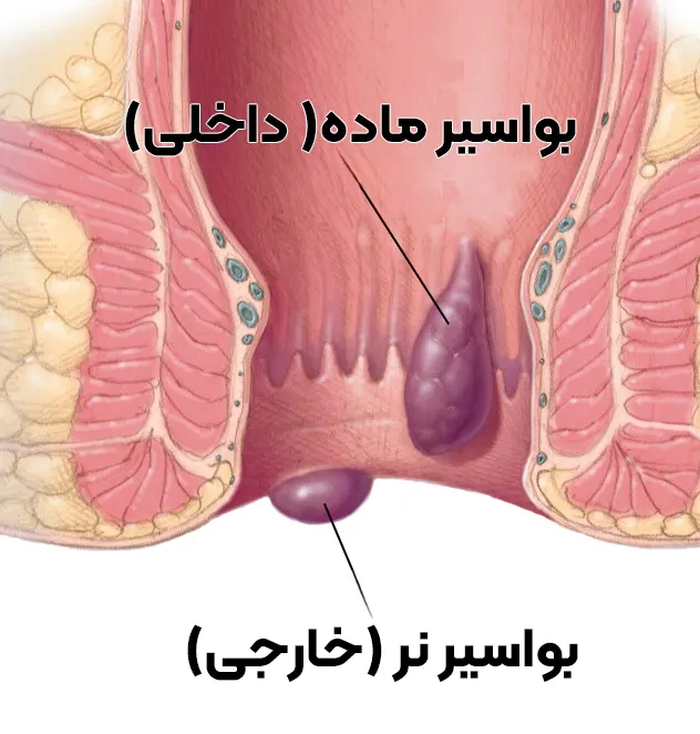 بواسیر نر و ماده