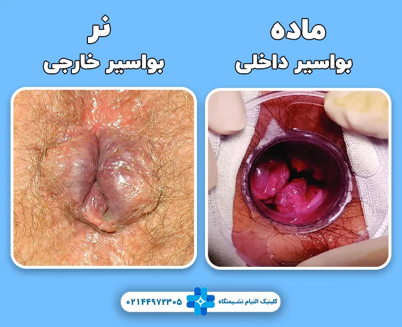 تفاوت بواسیر نر و ماده