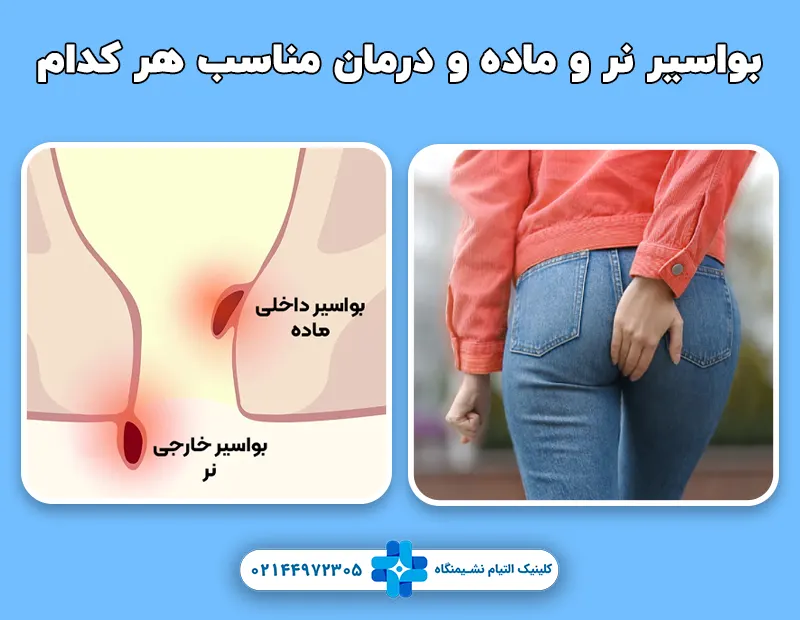 بواسیر نر و ماده