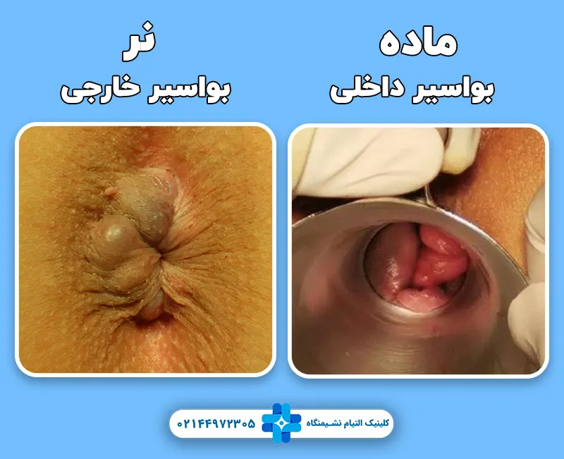 تفاوت بواسیر داخلی و خارجی