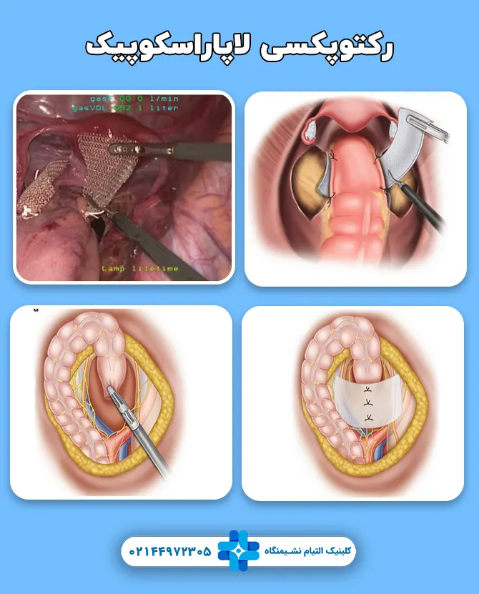 رکتوپکسی لاپاروسکوپیک