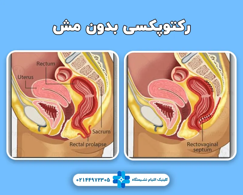 رکتوپکسی بدون مش