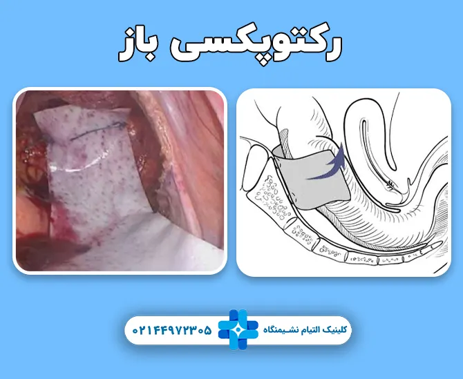 رکتوپکسی باز