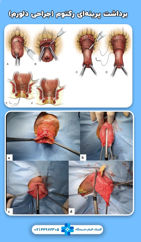 برداشت پرینه‌ای رکتوم