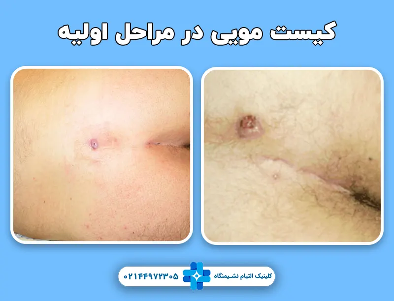 کیست مویی در مراحل اولیه