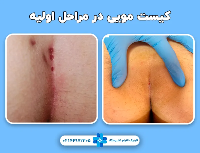 کیست مویی در مراحل اولیه
