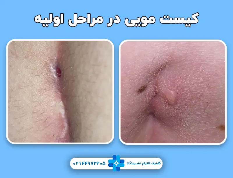 کیست مویی در مراحل اولیه