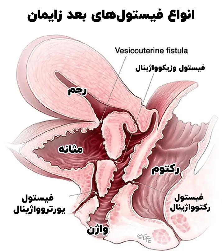 انواع فیستول‌ بعد زایمان