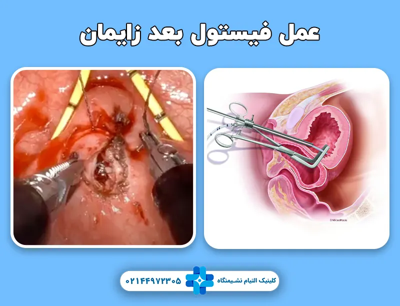 عمل فیستول بعد زایمان