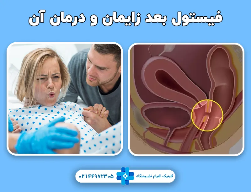 فیستول بعد از زایمان