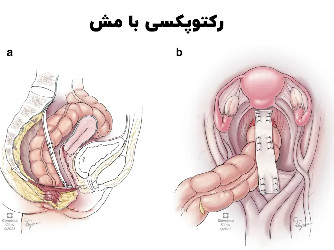 رکتوپکسی با مش