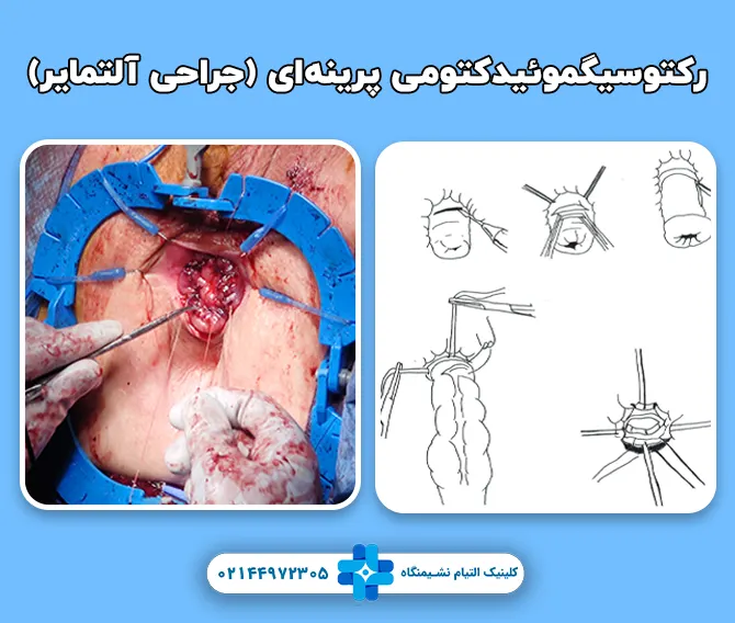 رکتوسیگموئیدکتومی پرینه‌ای