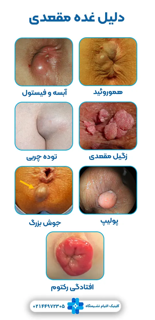 دلیل غده مقعدی چیست؟