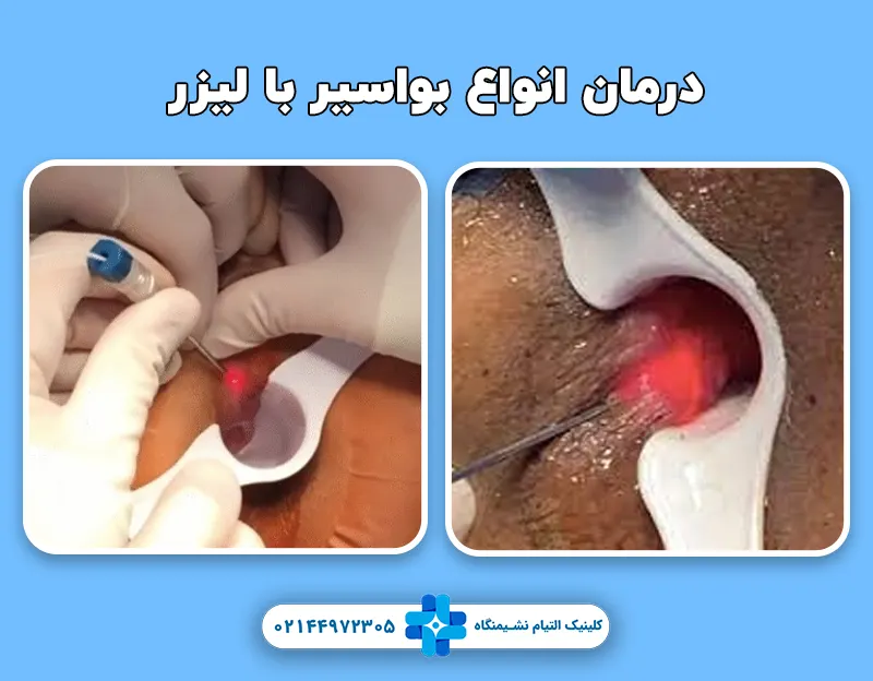 درمان بواسیر با لیزر