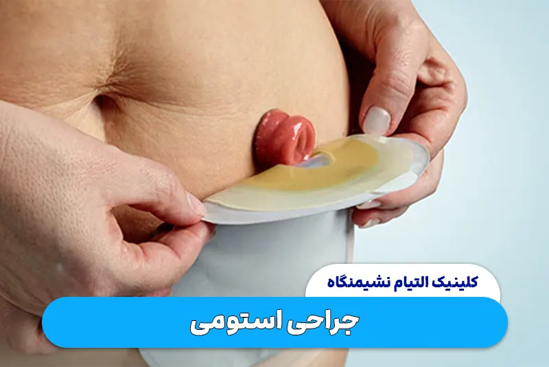 جراحی استومی