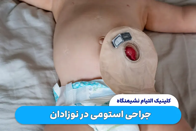 جراحی استومی در نوزادان