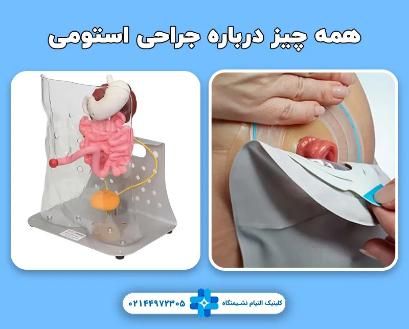 همه چیز درباره جراحی استومی