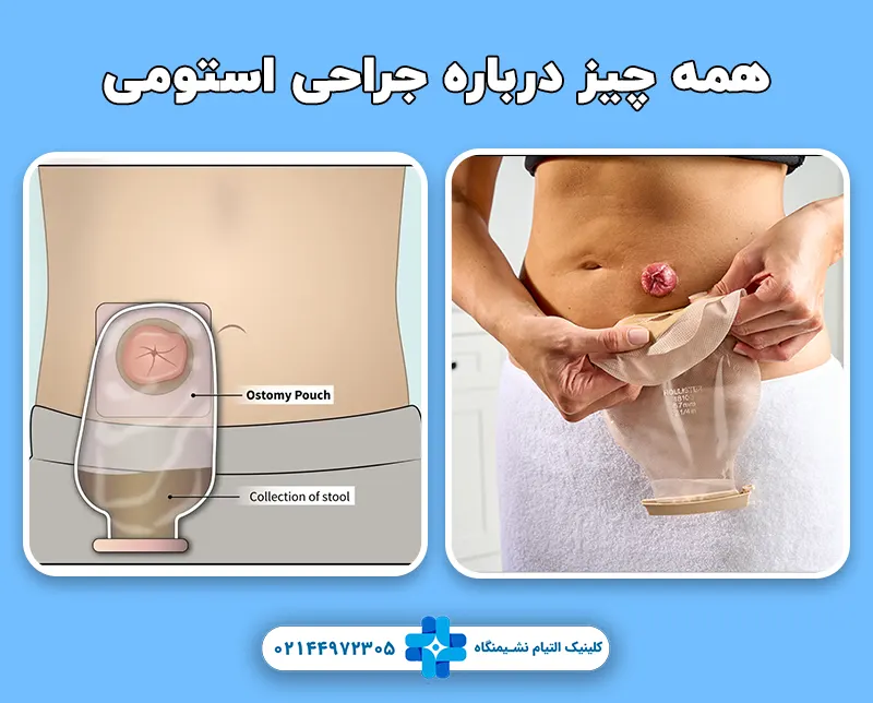همه چیز درباره جراحی استومی