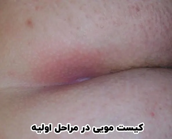 کیست مویی در مراحل اولیه