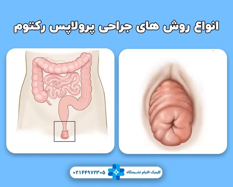 جراحی پروپلاپس رکتوم