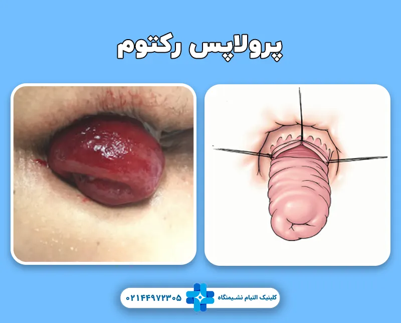 پرولاپس رکتوم