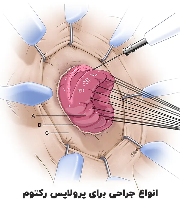 جراحی پرولاپس رکتوم