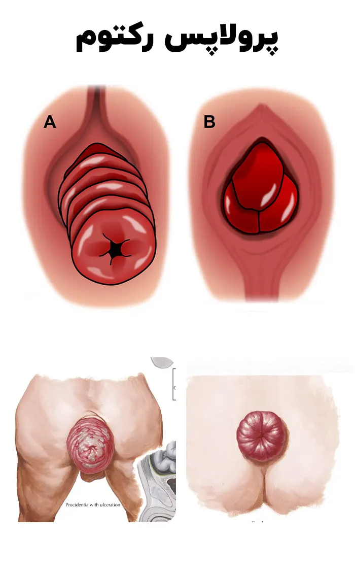 پرولاپس رکتوم