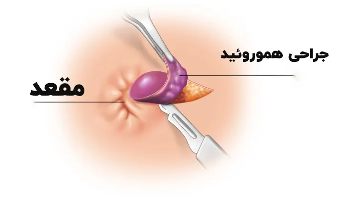 جراحی هموروئید