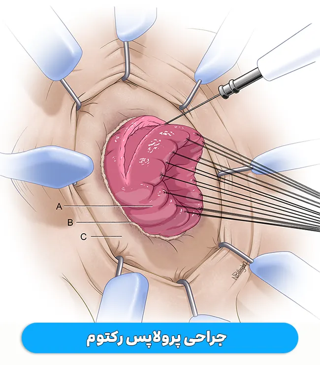 جراحی پرولاپس رکتوم