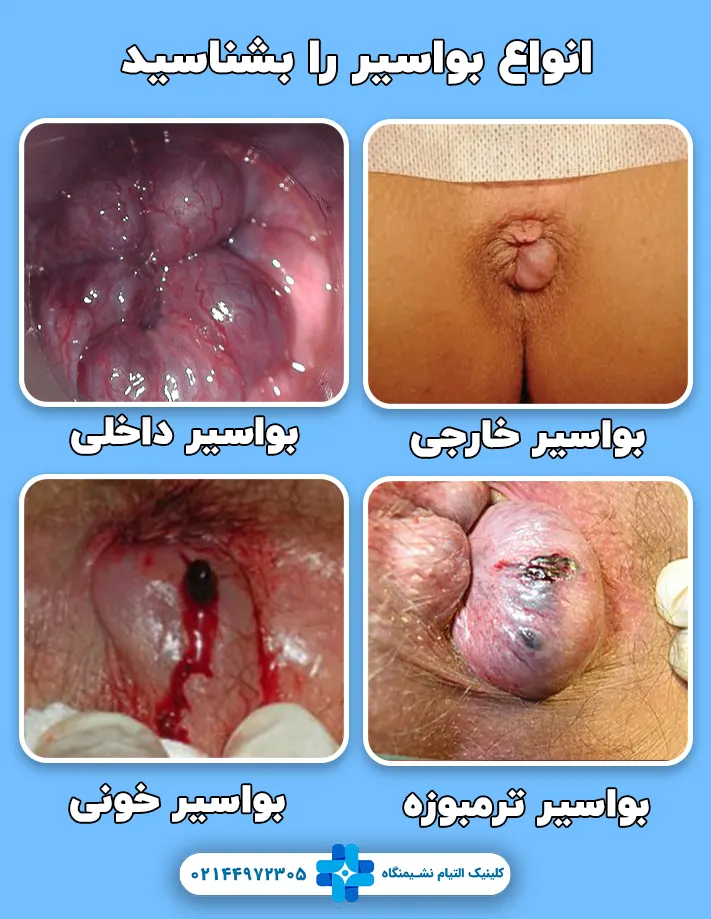عکس انواع بواسیر