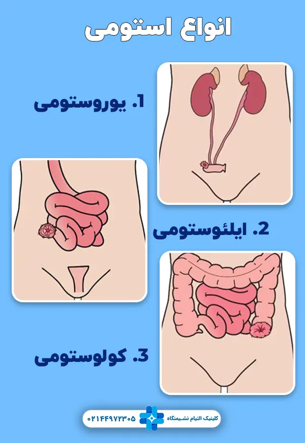 انواع استومی
