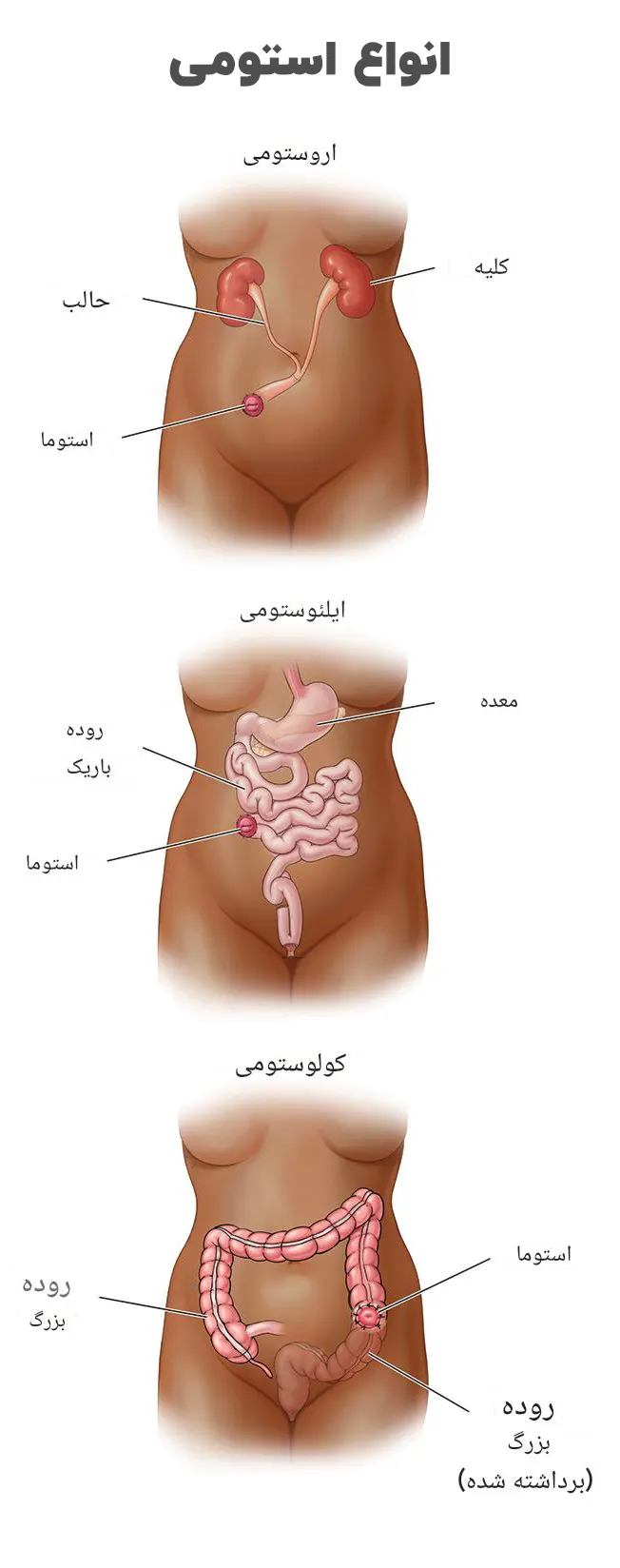 انواع استومی
