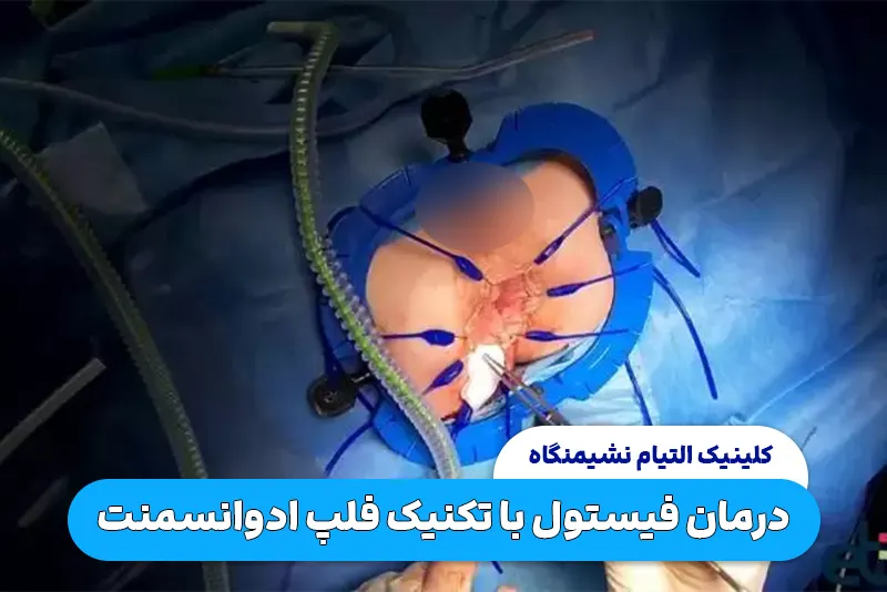 تکنیک فلپ ادوانسمنت برای درمان فیستول