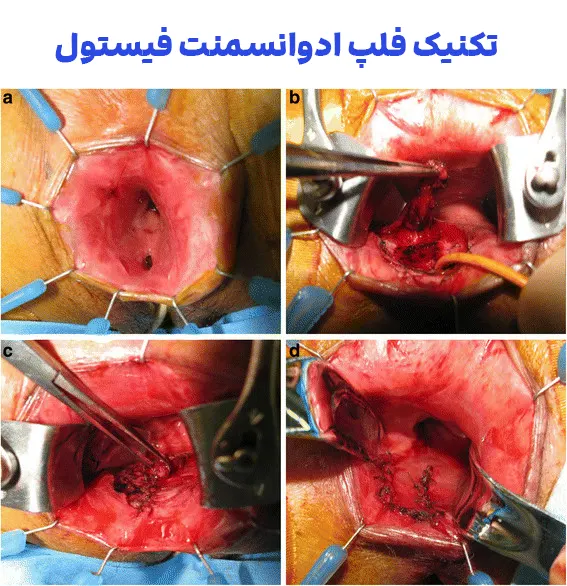 تکنیک فلپ ادوانسمنت برای درمان فیستول