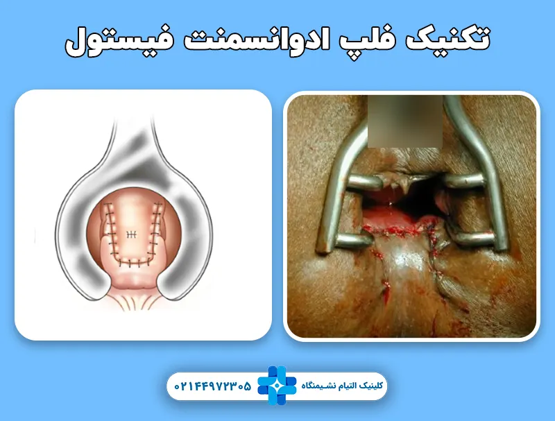 درمان فیستول با تکنیک فلپ ادوانسمنت