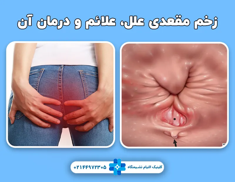 زخم مقعدی علل، علائم و درمان آن