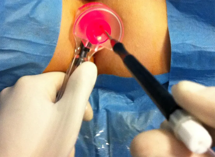 لیزر آبسه مقعد