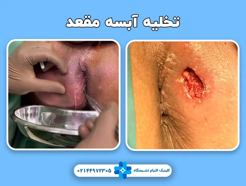 تخلیه آبسه مقعد