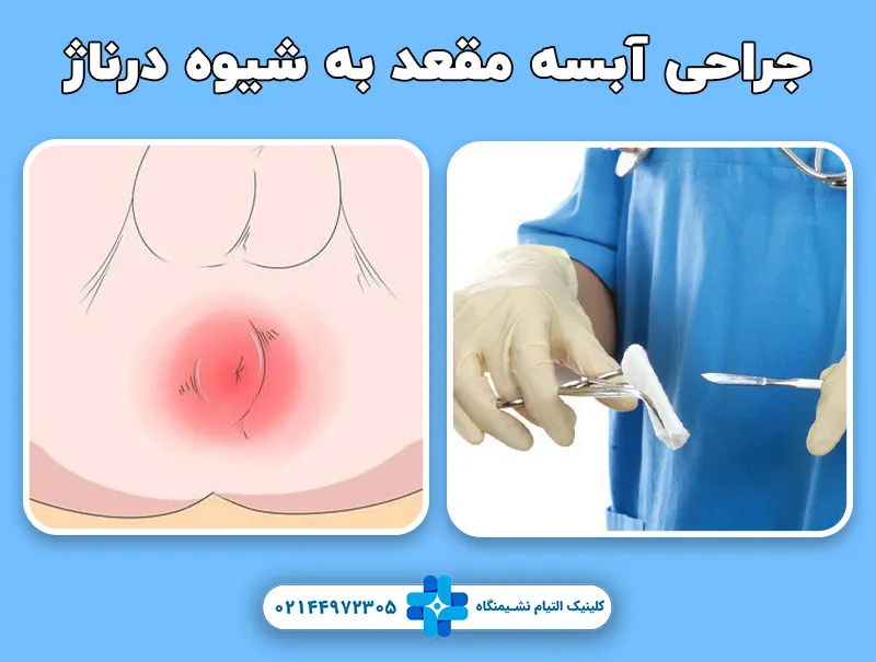 جراحی آبسه مقعد به شیوه درناژ