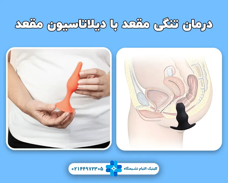 دیلاتاسیون مقعد