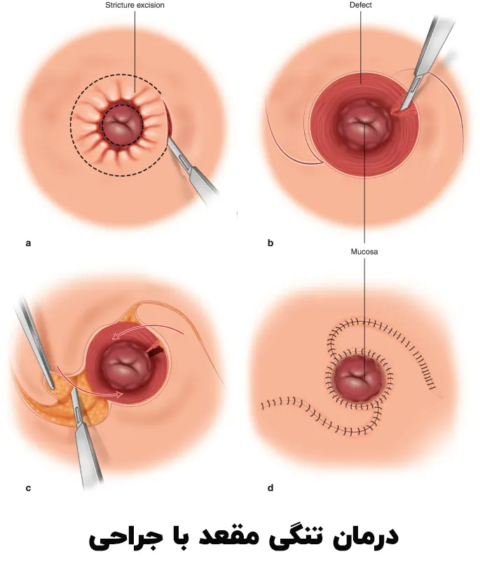 جراحی تنگی مقعد