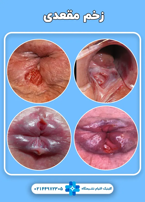 انواع زخم مقعدی