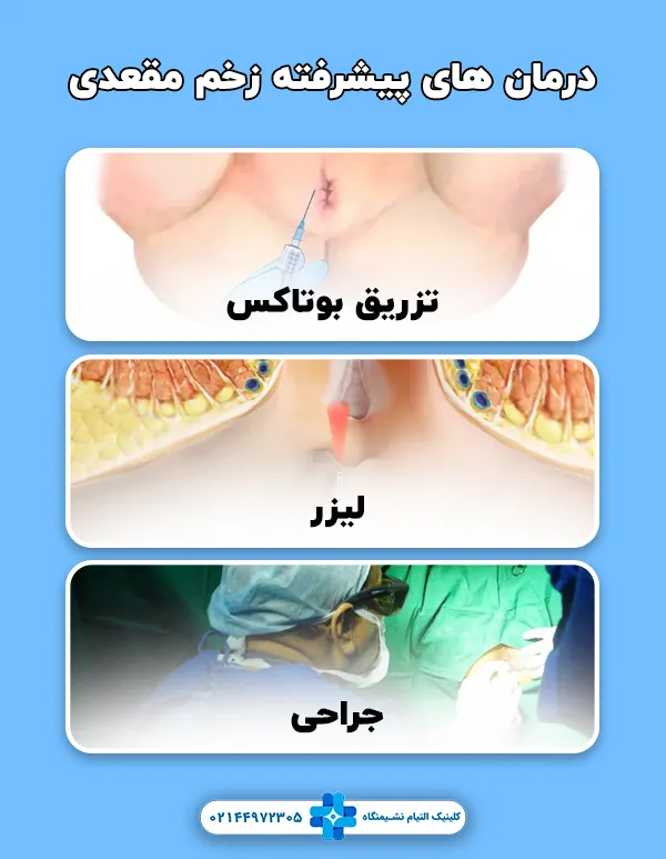 درمان های پیشرفته زخم مقعدی