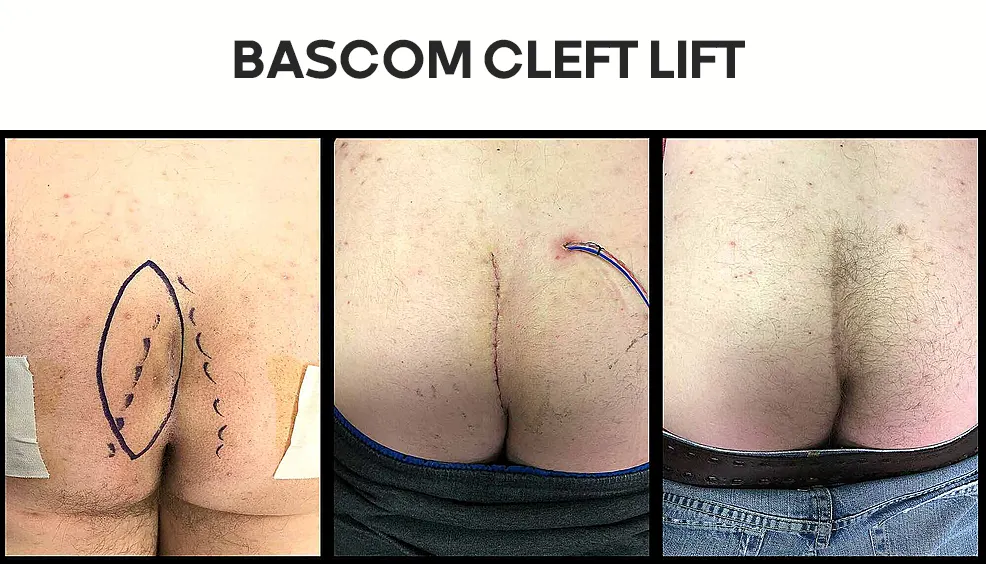 جراحی  به روش Bascom cleft lift 