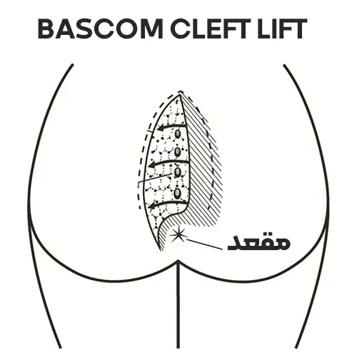 جراحی کیست مویی به روش Bascom cleft lift