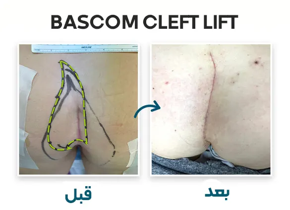 جراحی  به روش Bascom cleft lift 