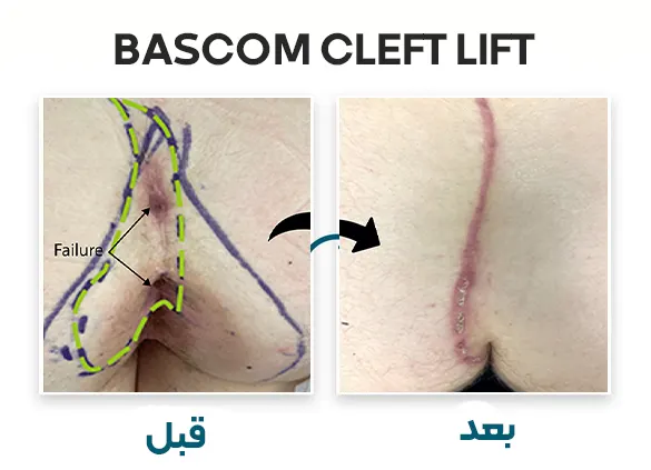 جراحی  به روش Bascom cleft lift 