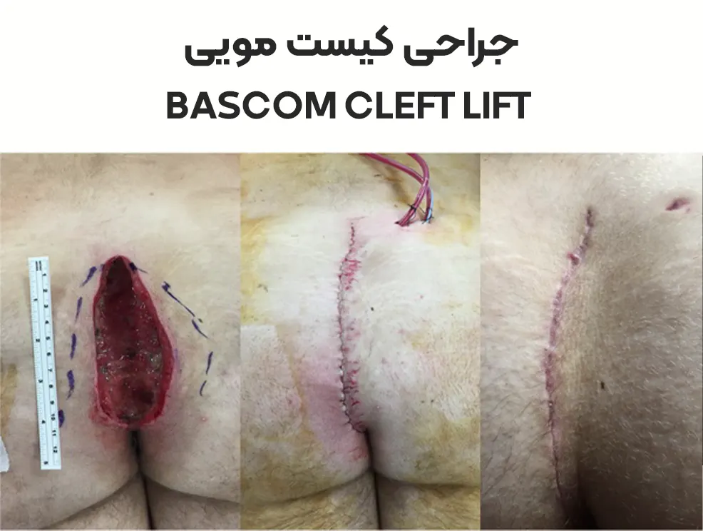 جراحی  به روش Bascom cleft lift 